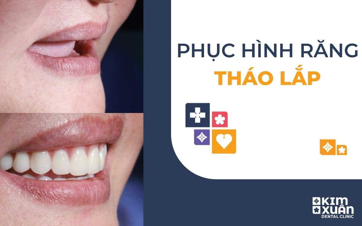 Phục Hình Răng Tháo Lắp