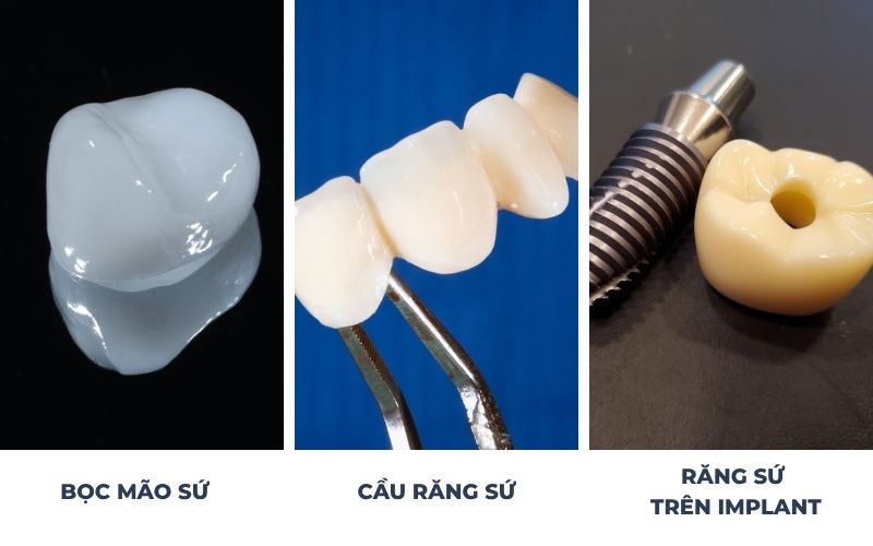 Phương Pháp Bọc Răng Sứ Phổ Biến