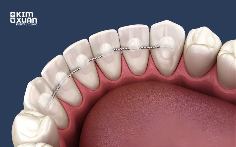 Phương Pháp Nẹp Răng Khi Răng Lung Lay