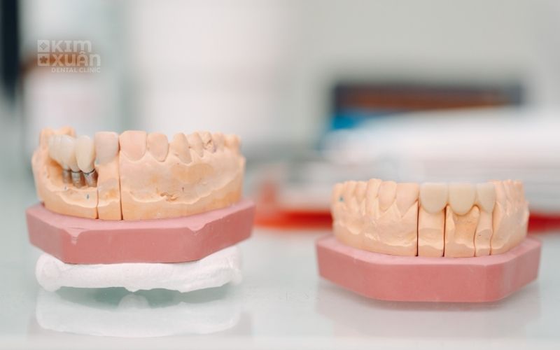 Phương Pháp Trồng Răng Giả Cho Người Già Tốt Nhất