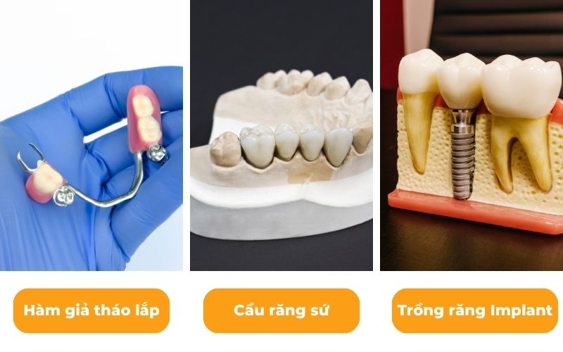 Các Phương Pháp Trồng Răng Hàm Phổ Biến Hiện Nay