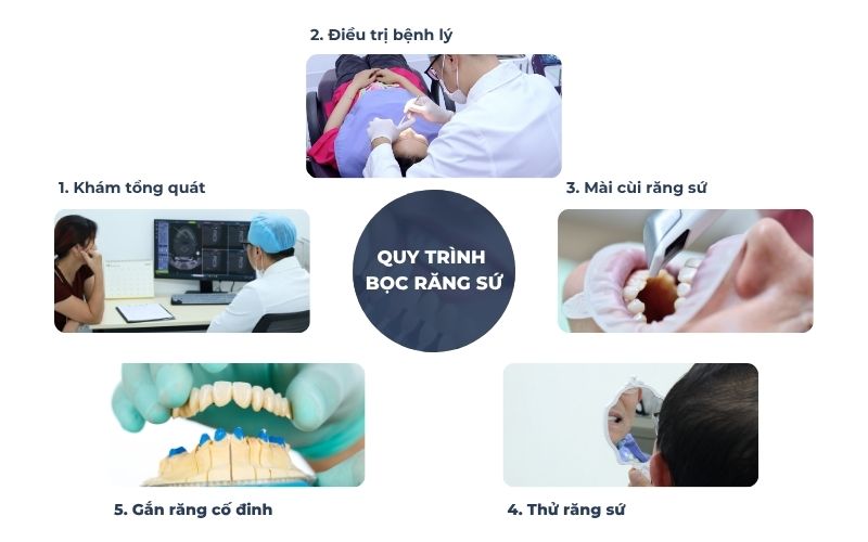Quy Trình Bọc Răng Sứ Tại Nha Khoa Kim Xuân