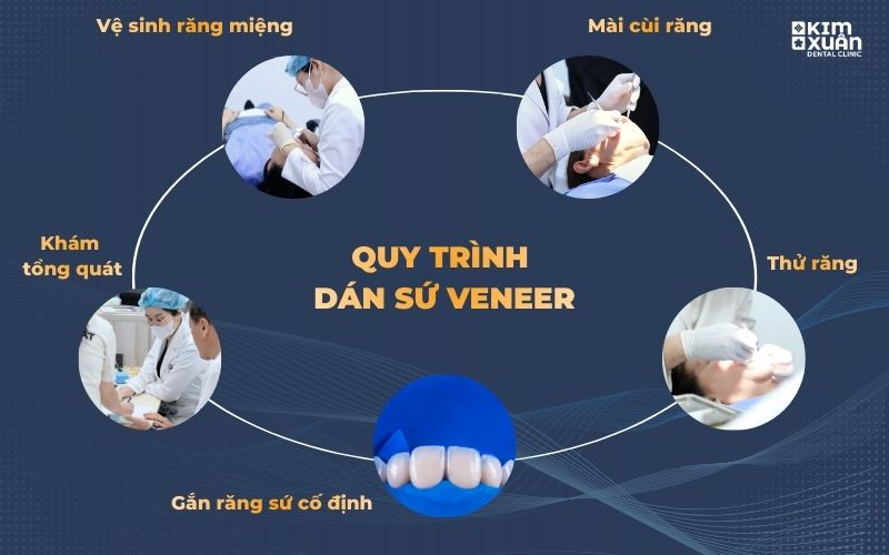 Quy Trình Bọc Răng Sứ Tại Nha Khoa Kim Xuân