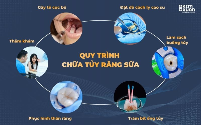 Quy trình chữa tủy răng cho trẻ em