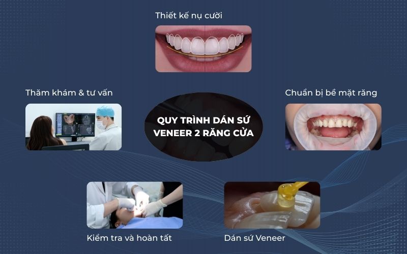 Quy trình Dán Sứ Veneer 2 Răng Cửa