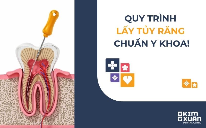 Quy Trình Điều Trị Tủy Răng