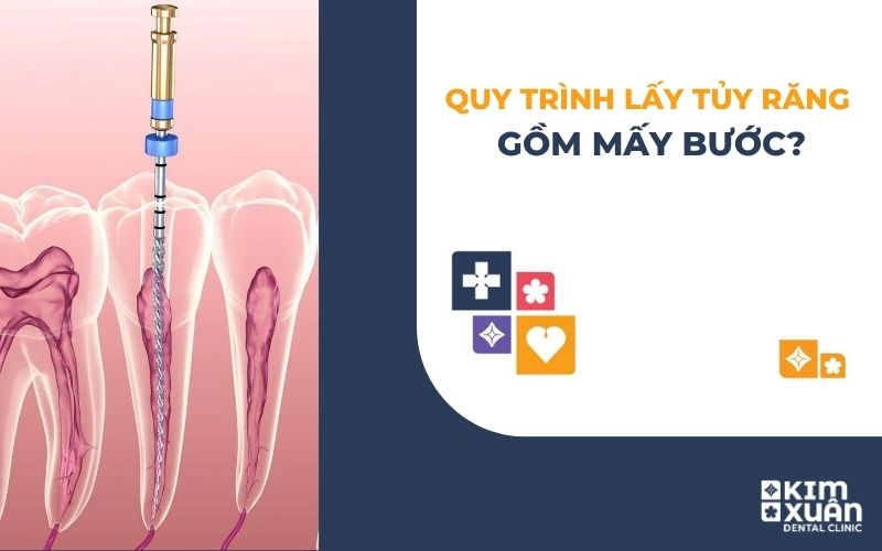 Quy Trình Điều Trị Tủy Răng