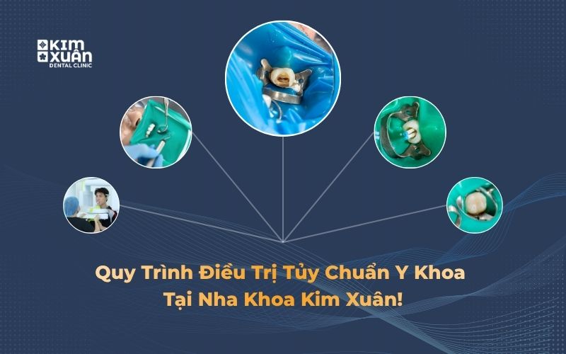 Quy trình điều trị tủy răng chuẩn y khoa