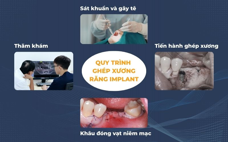 Quy Trình Ghép Xương Răng Chuẩn Y Khoa