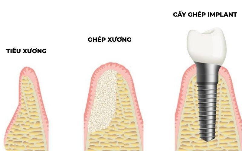 Quy Trình Ghép Xương Và Cấy Ghép Implant