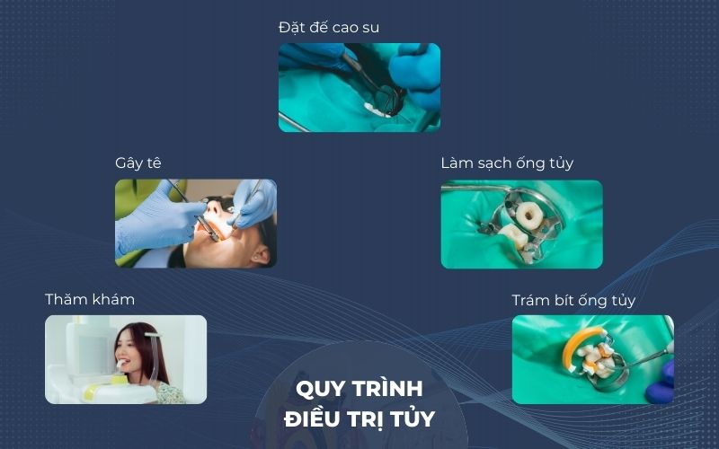 Quy trình Lấy Tủy Răng Chuẩn Y Khoa