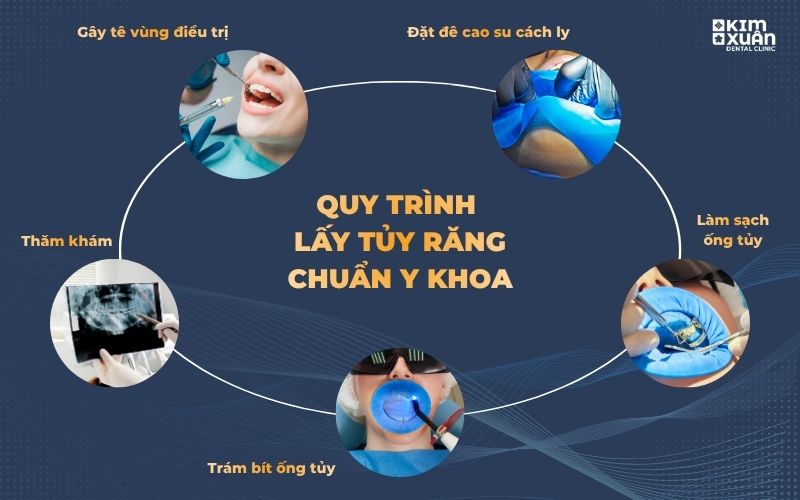 Quy Trình Lấy Tủy Răng Chuẩn Y Khoa