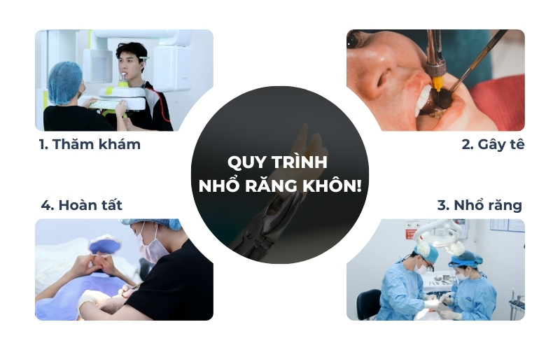 Quy Trình Nhổ Chuẩn Y Khoa Răng Khôn