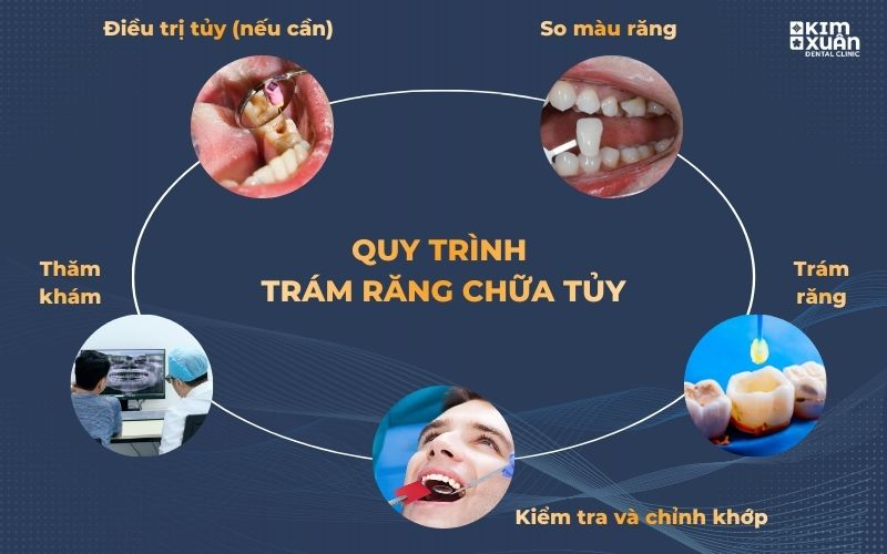 Quy Trình Trám Răng Chữa Tủy Tại Nha Khoa Kim Xuân