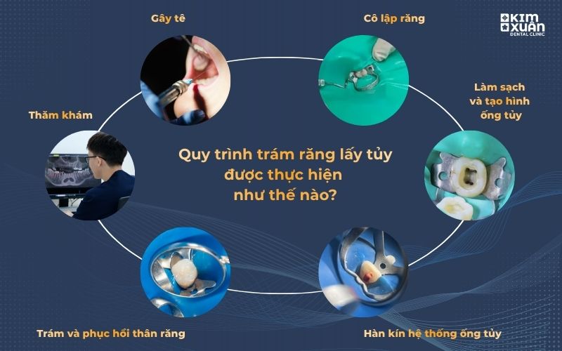 Quy trình trám răng lấy tủy tại nha khoa Kim Xuân