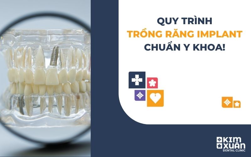 Quy Trình Trồng Răng Implant