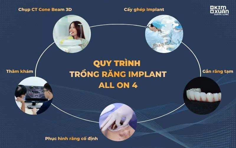 Quy Trình Trồng Răng Implant All On 4 Chuẩn Y Khoa Tại Nha Khoa Kim Xuân