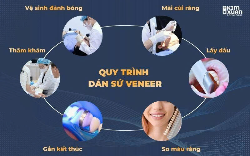 Quy Trình Dán Sứ Veneer Chuẩn Y Khoa