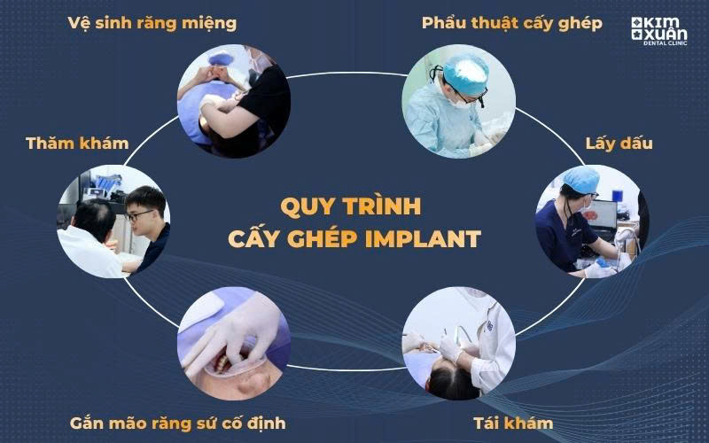 Quy Trình Trồng Răng Implant Chuẩn Y Khoa Tại Nha Khoa Kim Xuân