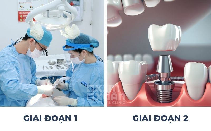 Quy Trình Trồng Răng Implant Mất Bao Lâu
