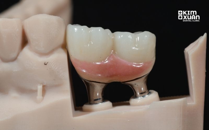 Răng sứ được gắn trên trụ implant trong quy trình trồng răng implant