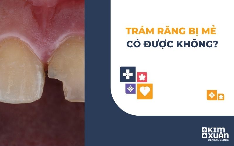Răng Bị Mẻ Có Trám Được Không
