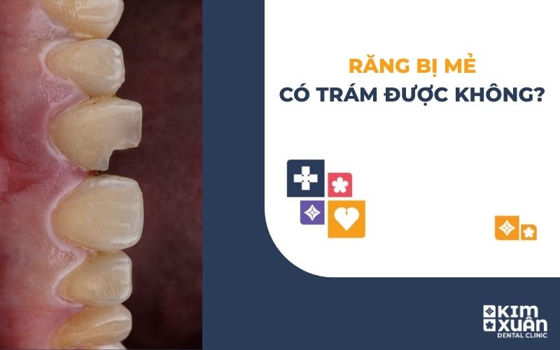 Răng Bị Mẻ Có Trám Được Không