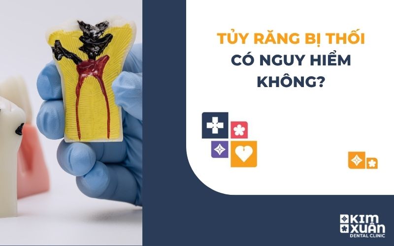 Răng Bị Thối Tủy Có Sao Không