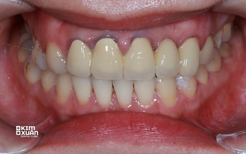Răng Bọc Sứ Bị Hở Có Nguy Hiểm Không