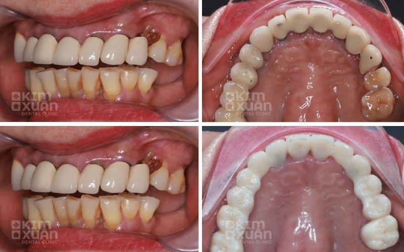 Răng Bọc Sứ Bị Viêm Tuỷ Có Nguy Hiểm Không