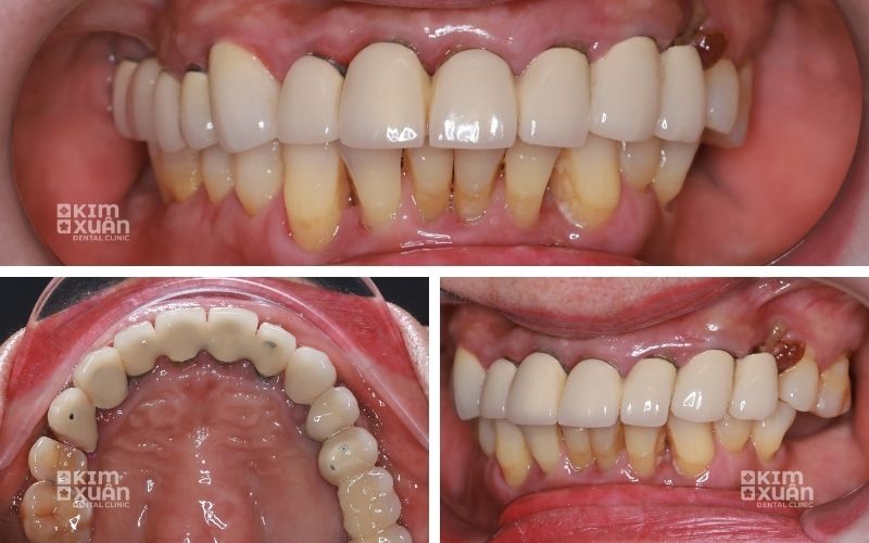 Hình ảnh lâm sàng răng bọc sứ bị viêm tủy, dấu hiệu viêm nướu và biến chứng sau bọc sứ