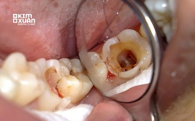 Răng Cấm Bị sâu