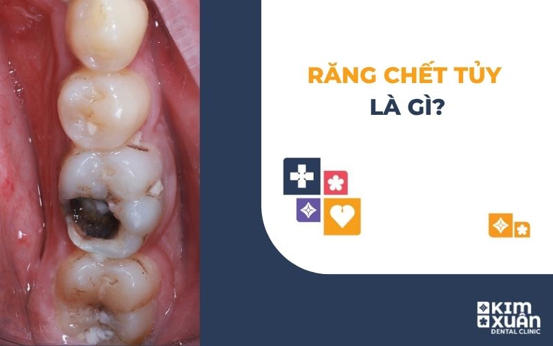 Răng Chết Tủy Là Gì