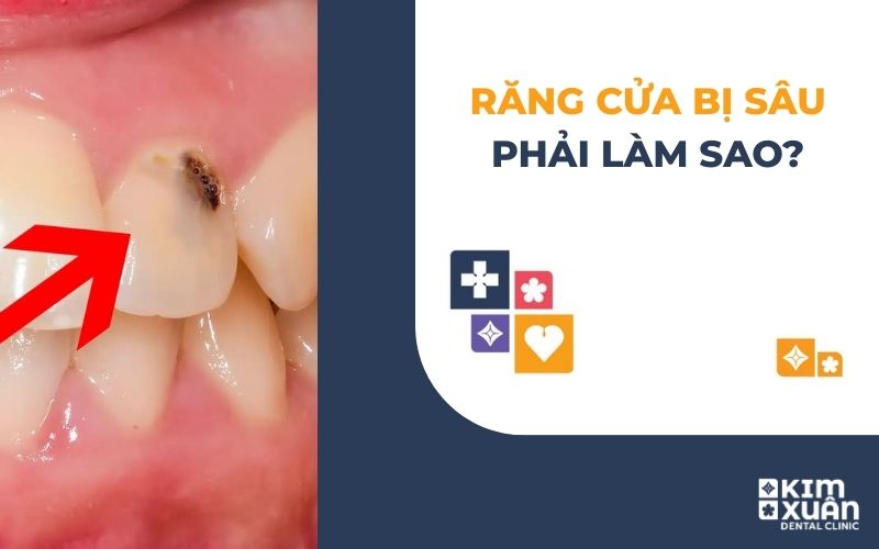 Răng Cửa Bị Sâu