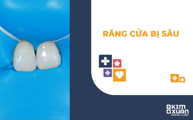 Răng Cửa Bị Sâu Nguyên Nhân