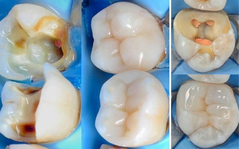Răng Đã Lấy Tủy Có Bền Không