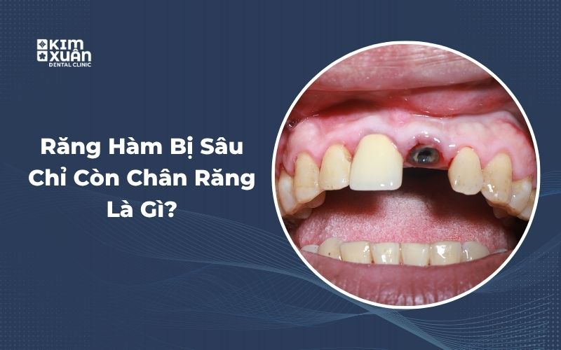 Răng Hàm Bị Sâu Chỉ Còn Chân Răng 