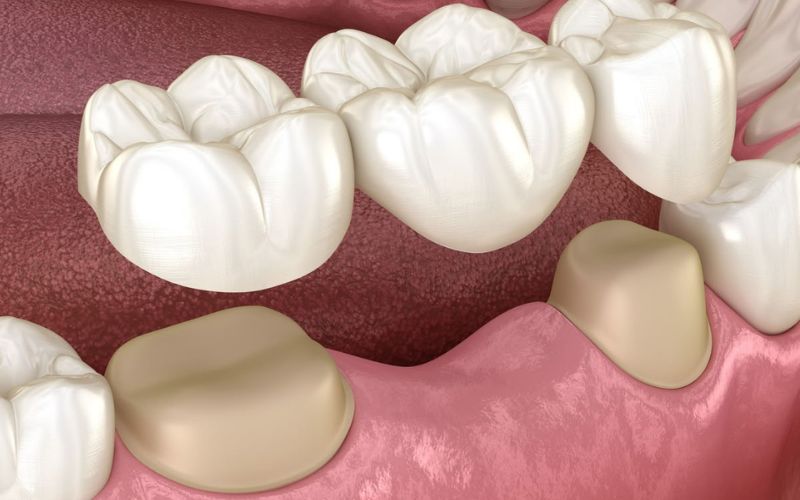 Răng Hàm Bị Sâu Có Bọc Sứ Được Không