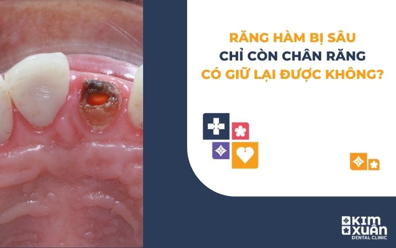 Răng Hàm Bị Sâu Chỉ Còn Chân Răng Có Giữ Được Không