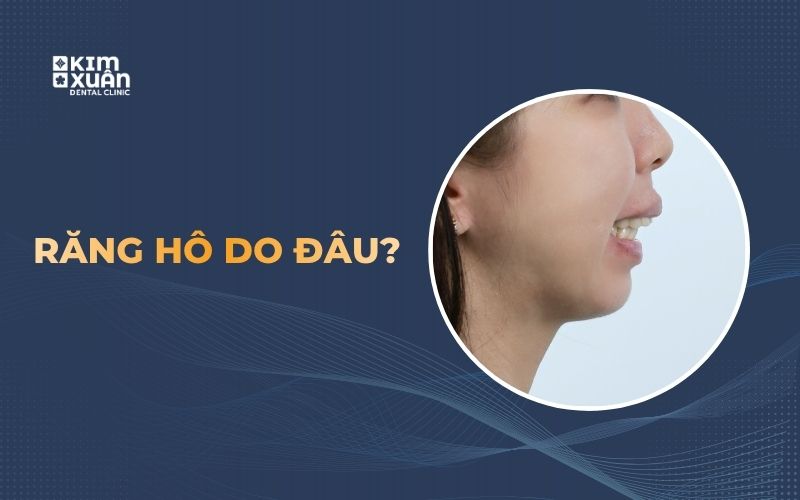 Răng hô