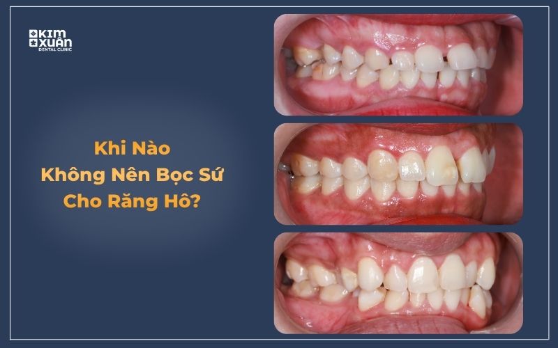 Răng hô có nên bọc răng sứ không