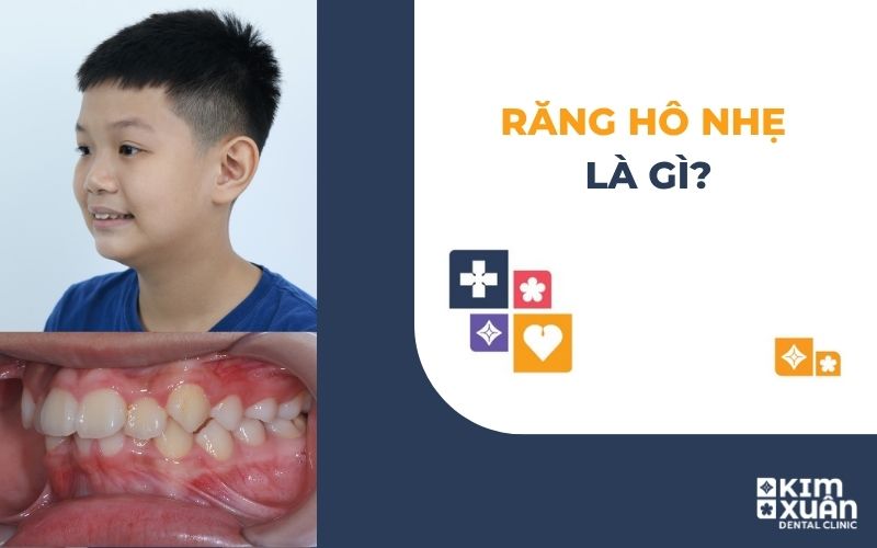 Răng Hô Nhẹ Có Nên Niềng Hay Không