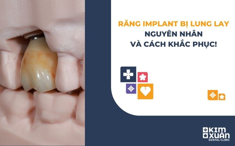 Răng Implant Bị Lung Lay