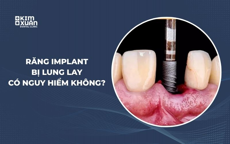 Răng Implant Bị Lung Lay Có Nguy Hiểm Không