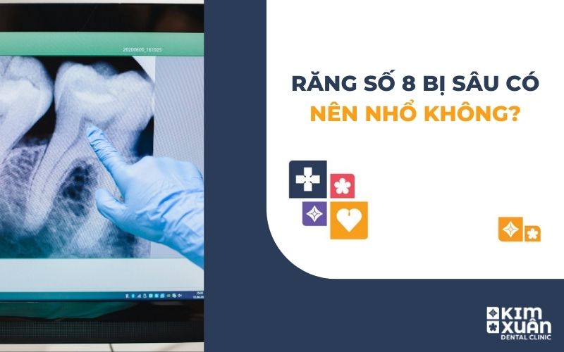 Răng Khôn Bị Sâu Có Nên Nhổ Không