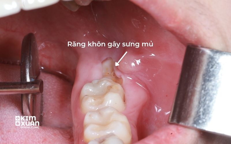 Răng Khôn Mọc Lệch Gây Sưng Nướu