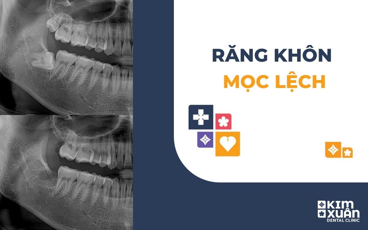 Răng Khôn Mọc Lệch Không Đau Có Nên Nhổ Không