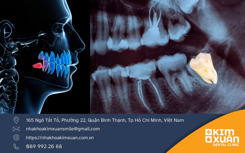 Răng Khôn Mọc Lệch Nhưng Không Đau Có Nên Nhổ Không