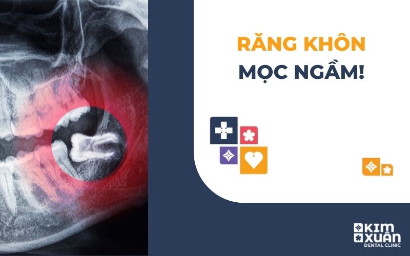 Răng Khôn Mọc Ngầm