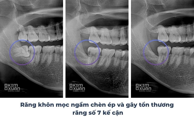 Răng Khôn Mọc Ngầm Có Nguy Hiểm Không
